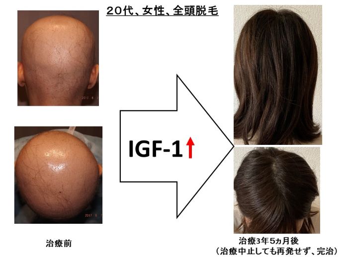 円形脱毛症　病院